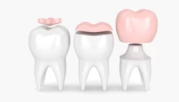 When Are Dental Inlays & Onlays Recommended – How To Care?