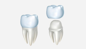 When Do You Need a Dental Crown?