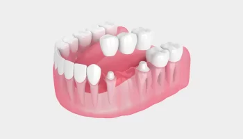Can a Dental Bridge Replace Teeth Without Surgery?